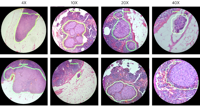 An Augmented Reality Microscope for Cancer Detection